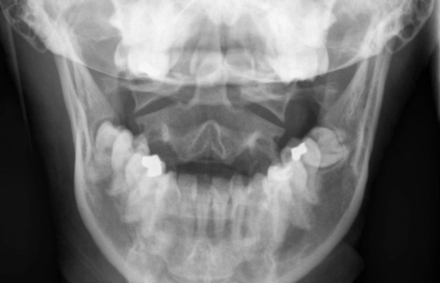 Possible broken jaw in Children Anchorage Pediatric Dentistry